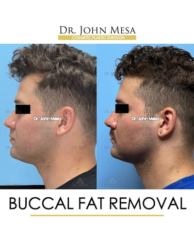 Buccal Fat Pad Removal for Men Before & After Gallery - Patient 174900507 - Image 6