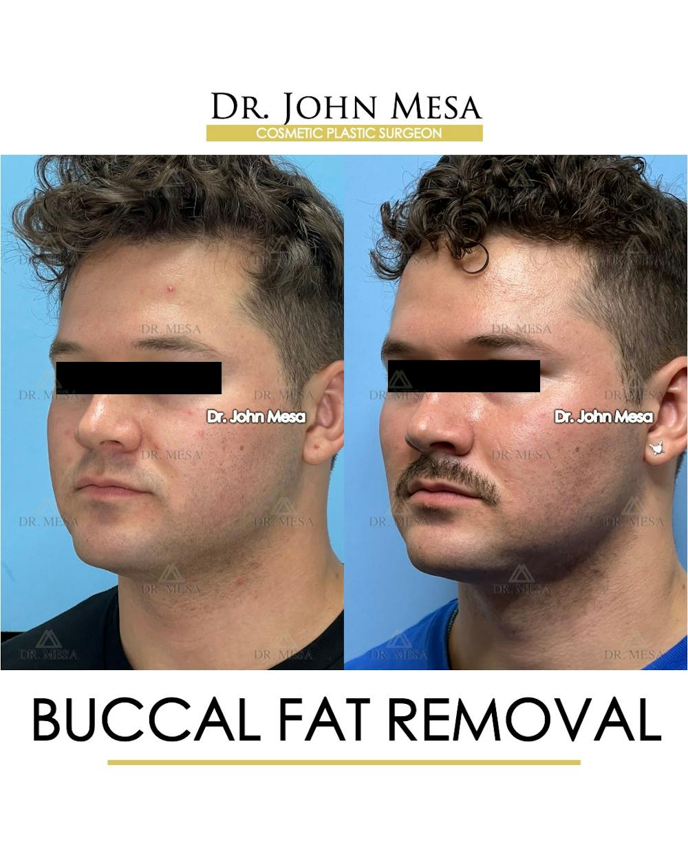 Buccal Fat Pad Removal for Men Before & After Gallery - Patient 174900507 - Image 5