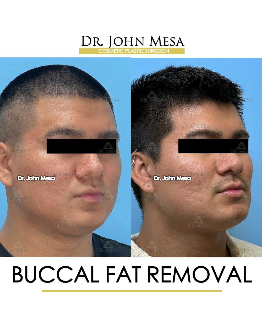 Buccal Fat Pad Removal for Men Before & After Gallery - Patient 174900584 - Image 2