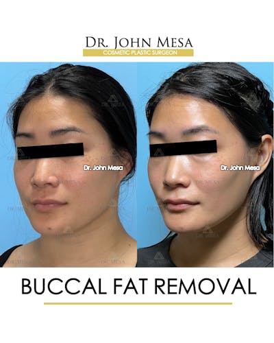 Buccal Fat Pad Removal Before & After Gallery - Patient 174900496 - Image 4