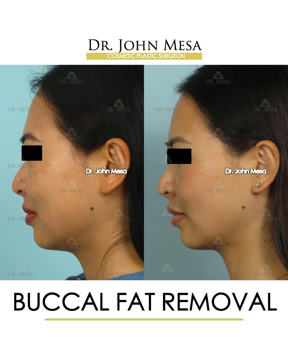 Buccal Fat Pad Removal Before & After Gallery - Patient 174900493 - Image 5