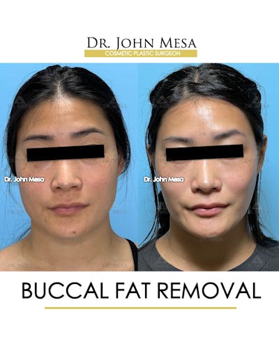 Buccal Fat Pad Removal Before & After Gallery - Patient 174900496 - Image 1