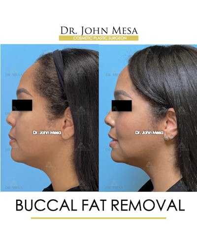 Buccal Fat Pad Removal Before & After Gallery - Patient 174900500 - Image 6