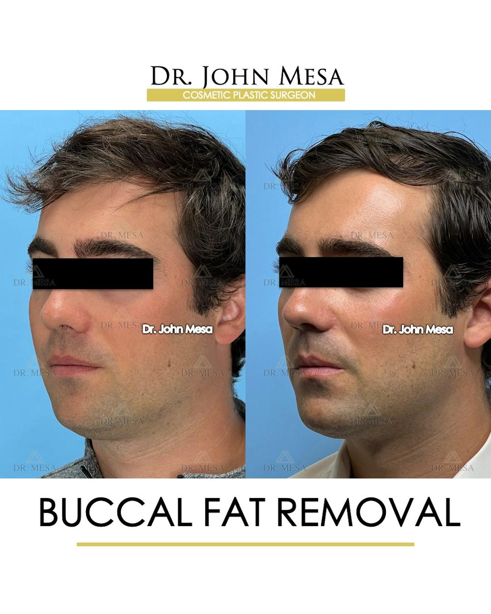 Buccal Fat Pad Removal for Men Before & After Gallery - Patient 174900776 - Image 5