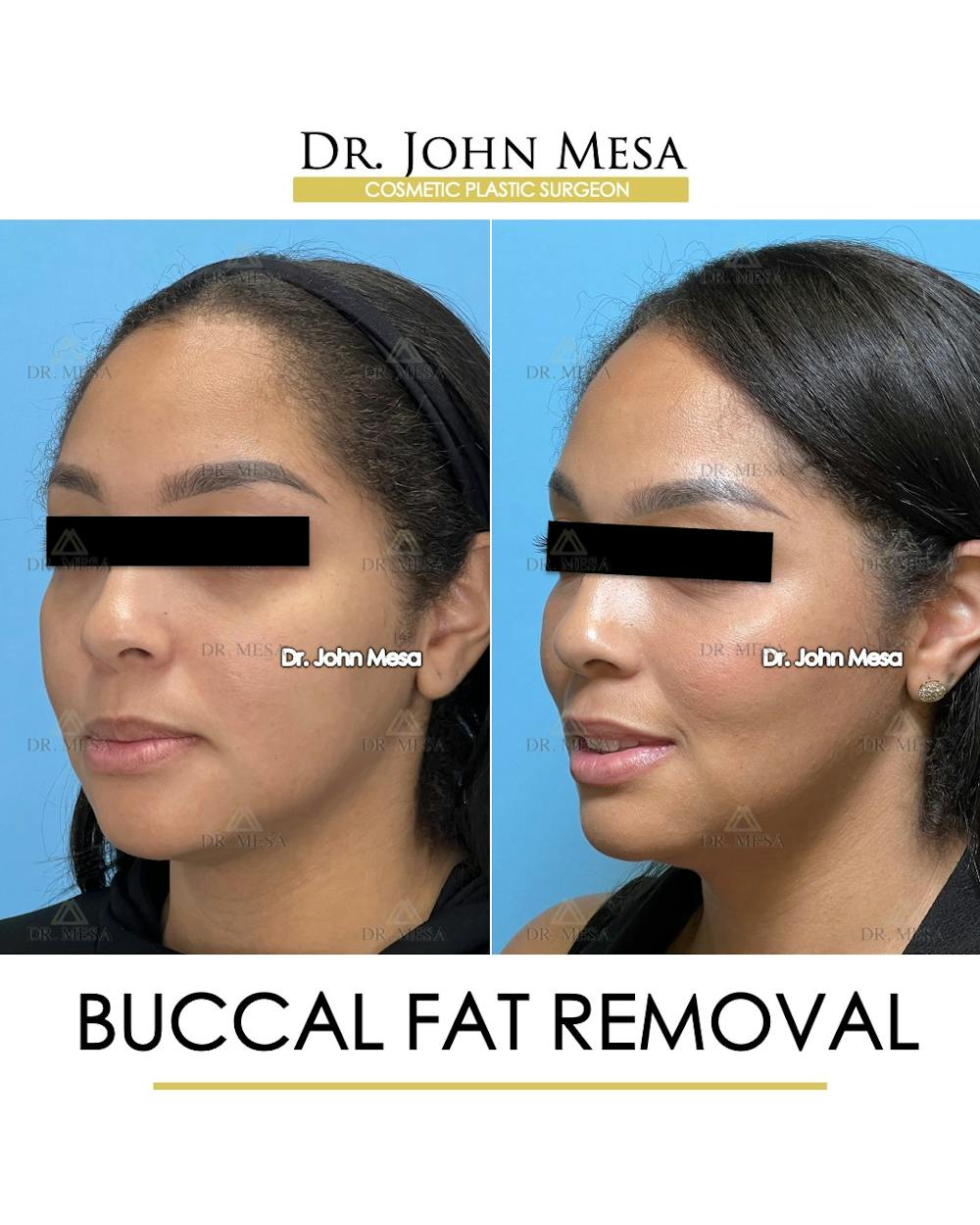 Buccal Fat Pad Removal Before & After Gallery - Patient 174900500 - Image 5