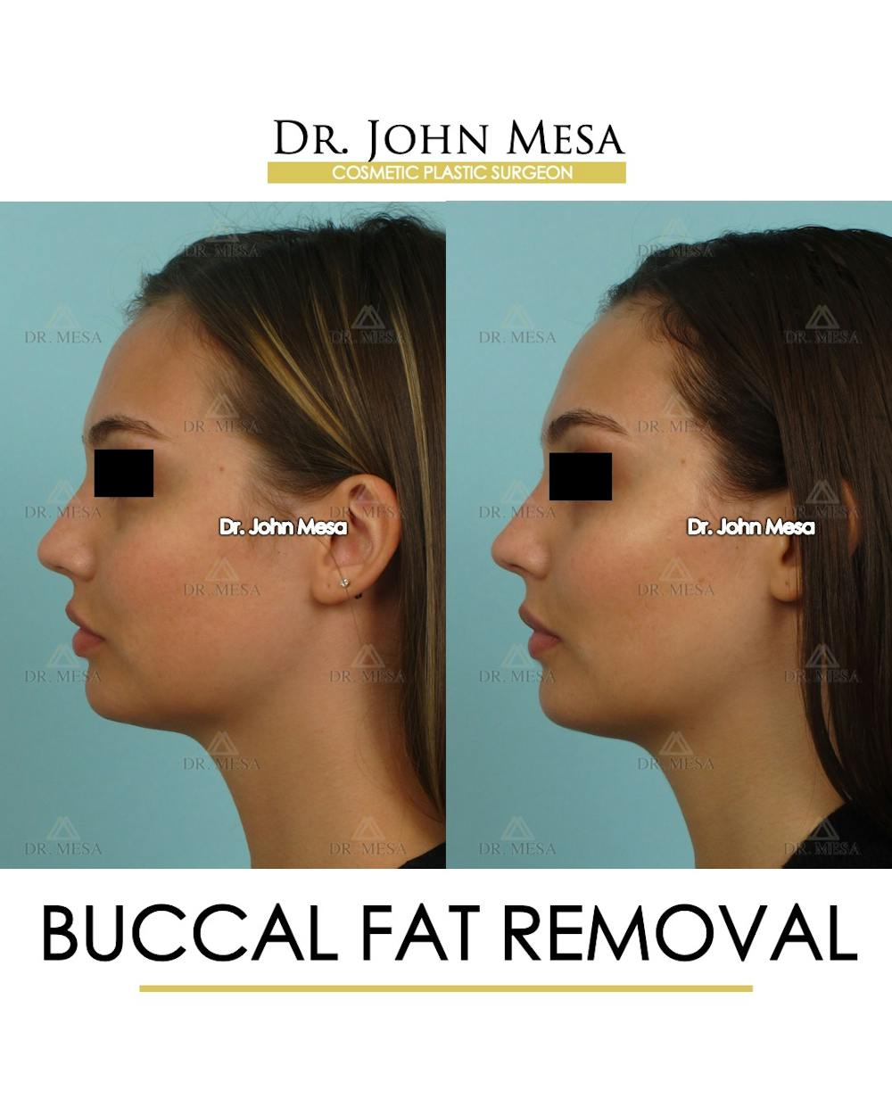 Buccal Fat Pad Removal Before & After Gallery - Patient 174900495 - Image 5