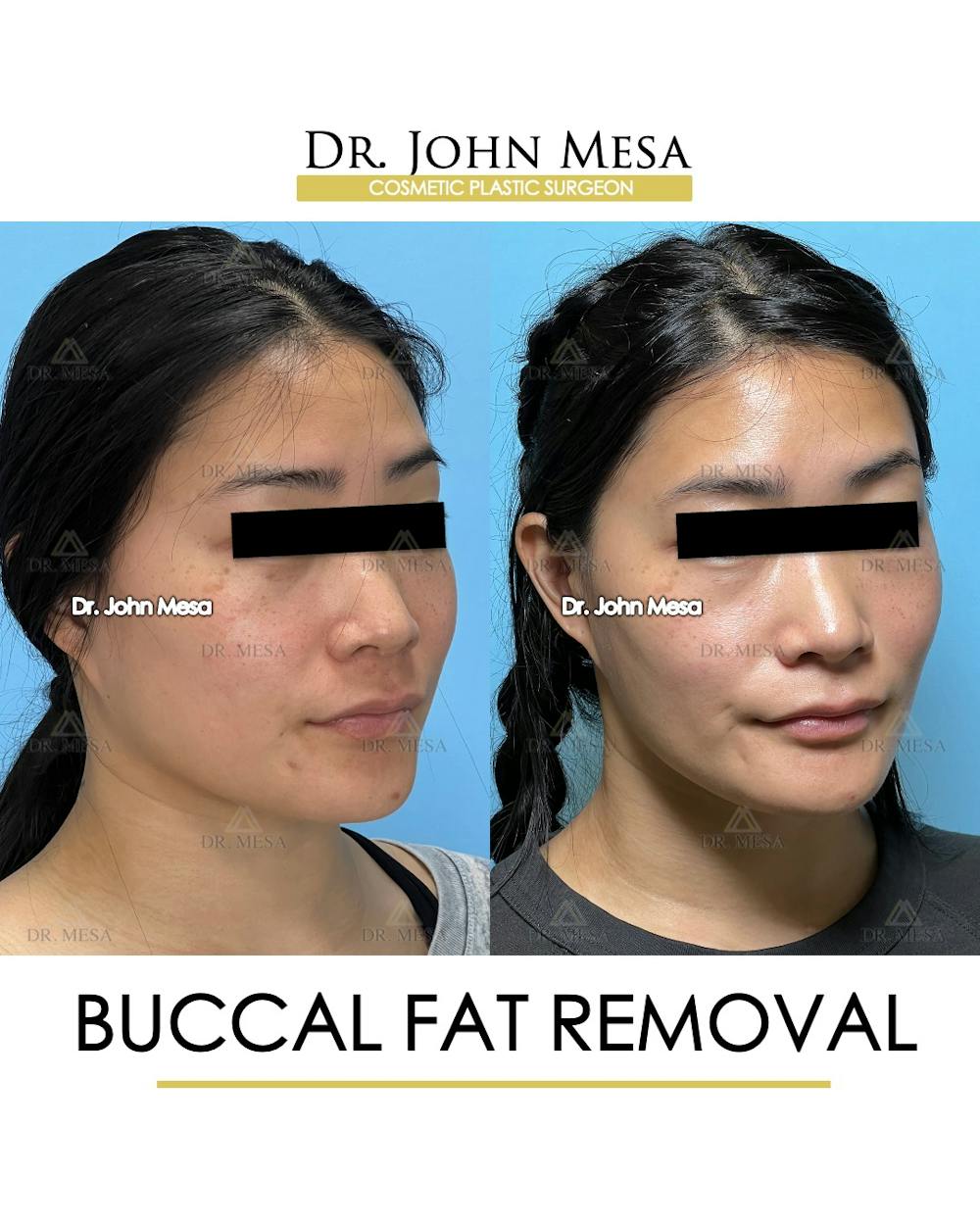 Buccal Fat Pad Removal Before & After Gallery - Patient 174900496 - Image 2