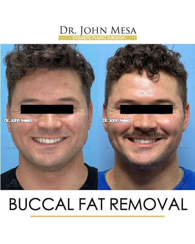 Buccal Fat Pad Removal for Men Before & After Gallery - Patient 174900507 - Image 2