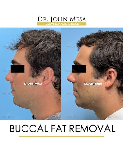 Buccal Fat Pad Removal for Men Before & After Gallery - Patient 174900776 - Image 4