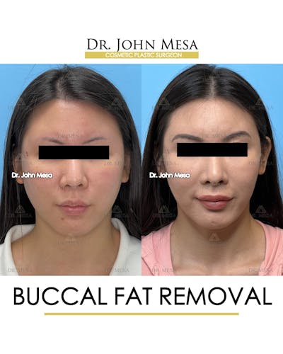 Buccal Fat Pad Removal Before & After Gallery - Patient 174900494 - Image 1
