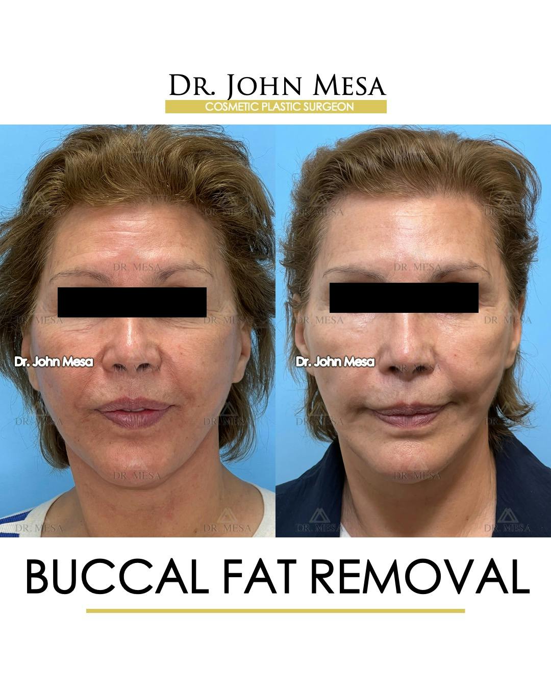 Buccal Fat Pad Removal Before & After Gallery - Patient 174900505 - Image 1