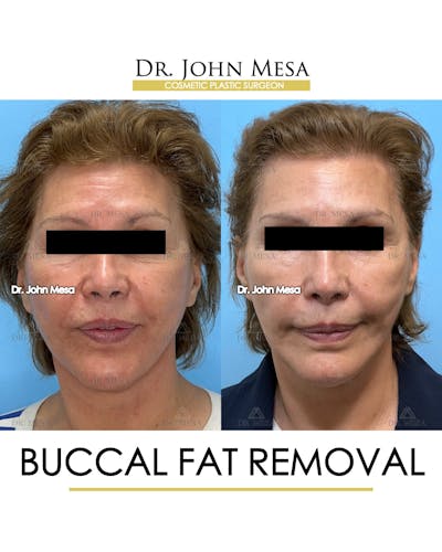 Buccal Fat Pad Removal Before & After Gallery - Patient 174900505 - Image 1
