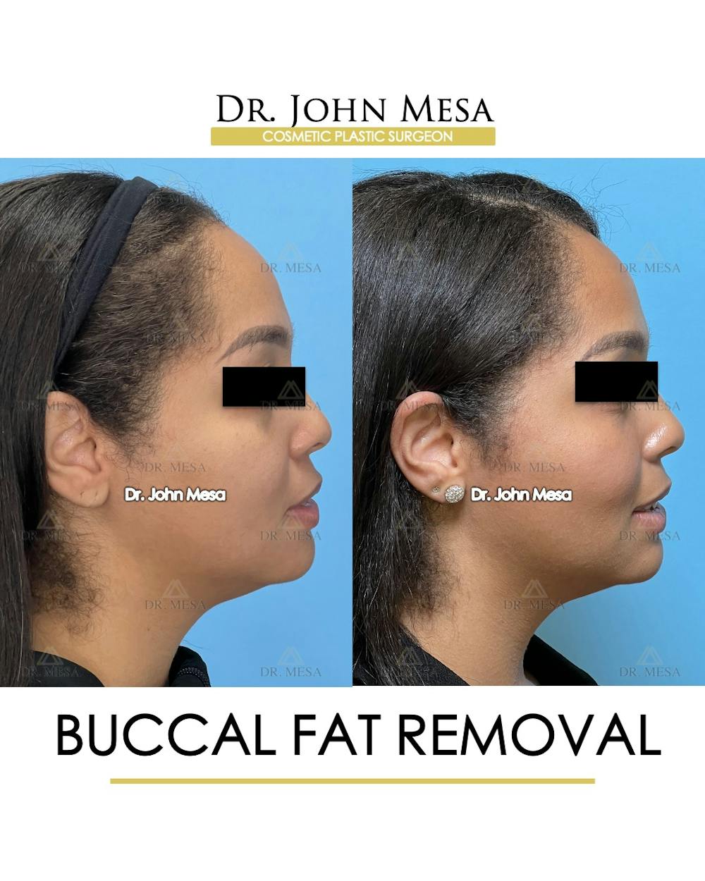 Buccal Fat Pad Removal Before & After Gallery - Patient 174900500 - Image 4