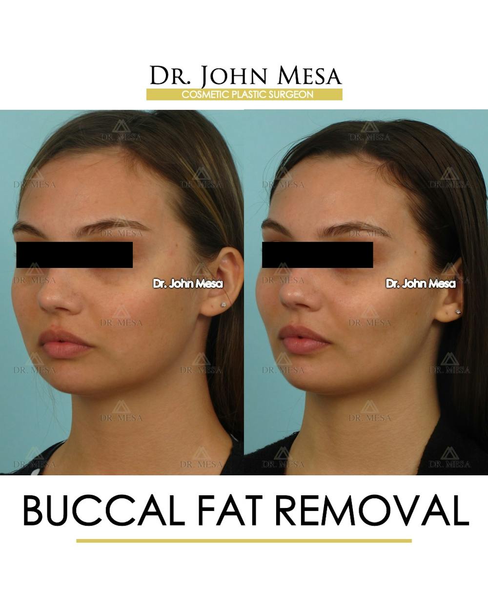Buccal Fat Pad Removal Before & After Gallery - Patient 174900495 - Image 4