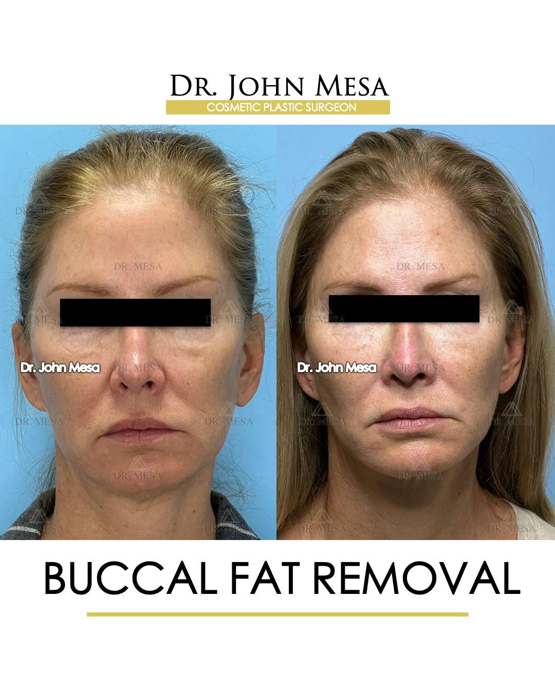 Buccal Fat Pad Removal Before & After Gallery - Patient 174900506 - Image 1