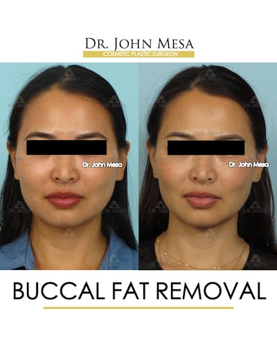 Buccal Fat Pad Removal Before & After Gallery - Patient 174900493 - Image 1