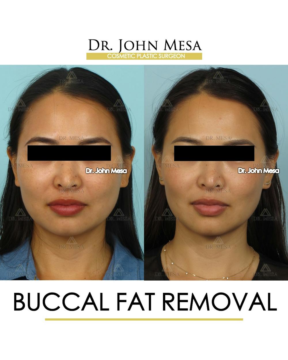 Buccal Fat Pad Removal Before & After Gallery - Patient 174900493 - Image 1