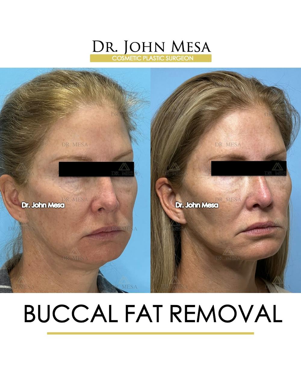 Buccal Fat Pad Removal Before & After Gallery - Patient 174900506 - Image 2
