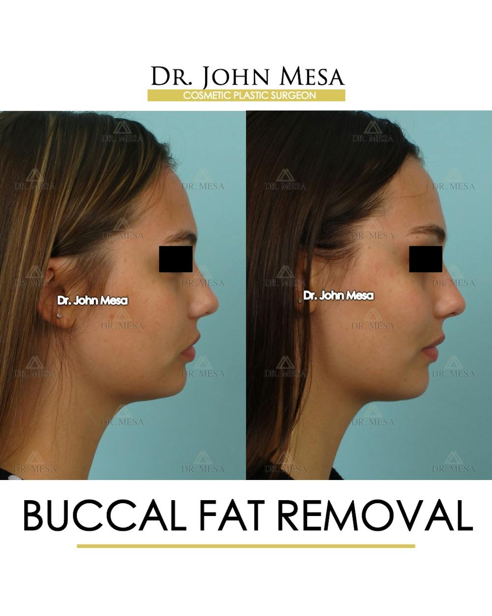 Buccal Fat Pad Removal Before & After Gallery - Patient 174900495 - Image 3