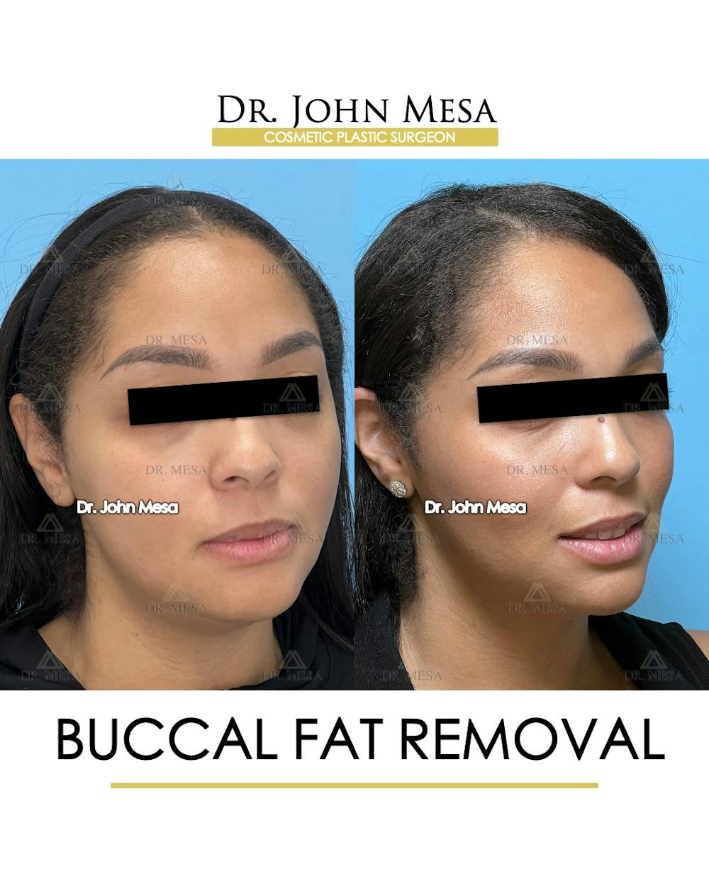 Buccal Fat Pad Removal Before & After Gallery - Patient 174900500 - Image 3