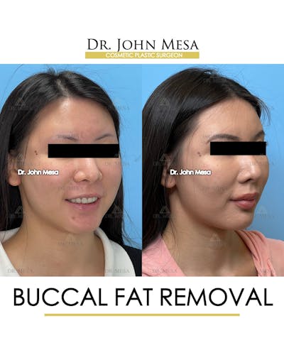Buccal Fat Pad Removal Before & After Gallery - Patient 174900494 - Image 2
