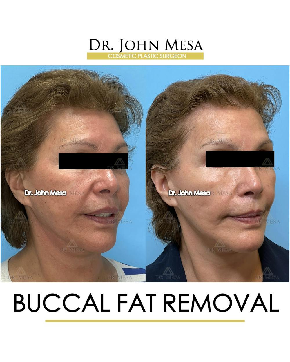 Buccal Fat Pad Removal Before & After Gallery - Patient 174900505 - Image 2