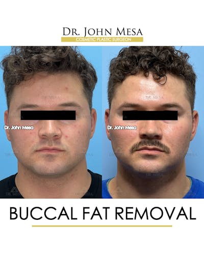 Buccal Fat Pad Removal for Men Before & After Gallery - Patient 174900507 - Image 1