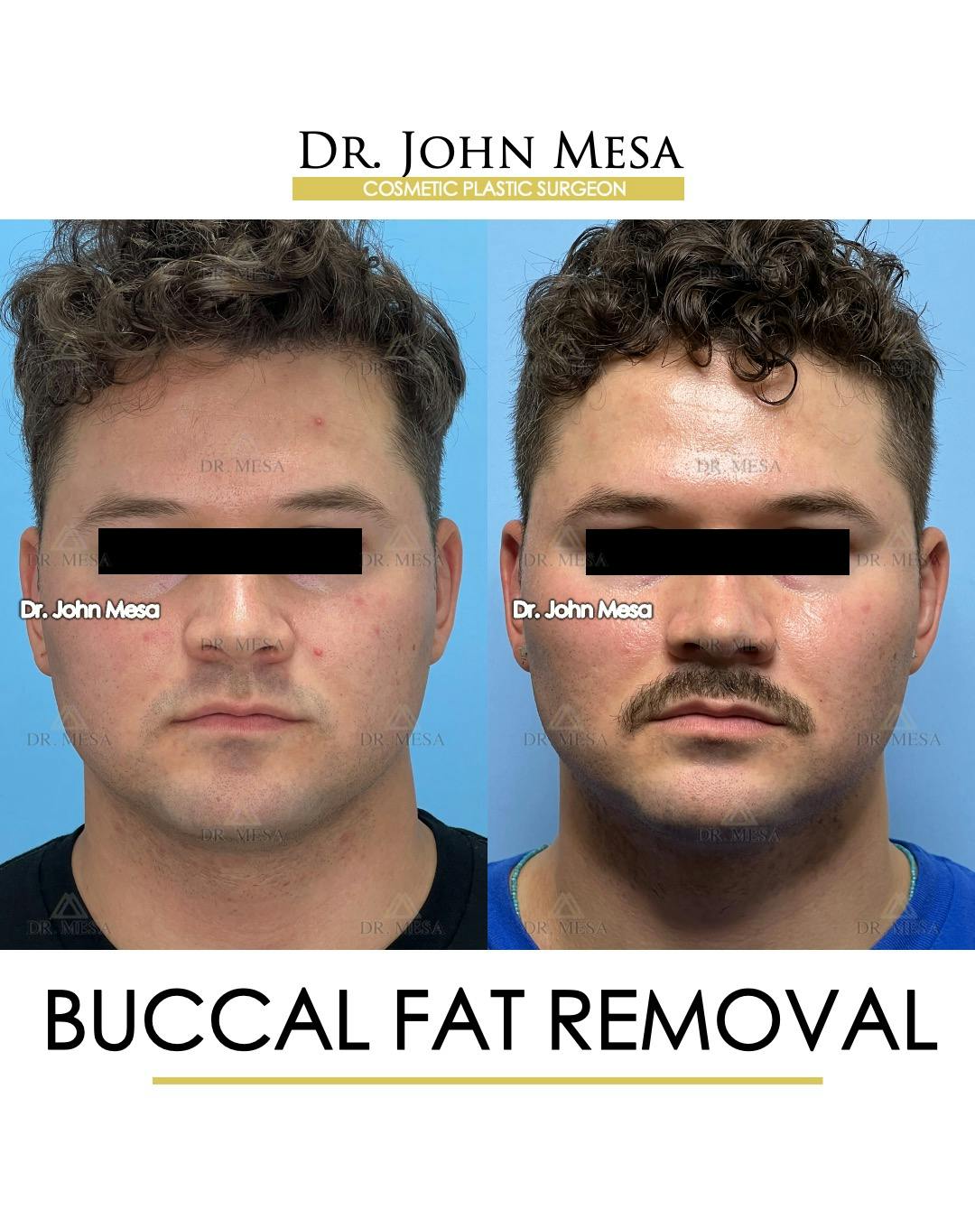 Buccal Fat Pad Removal for Men Before & After Gallery - Patient 174900507 - Image 1