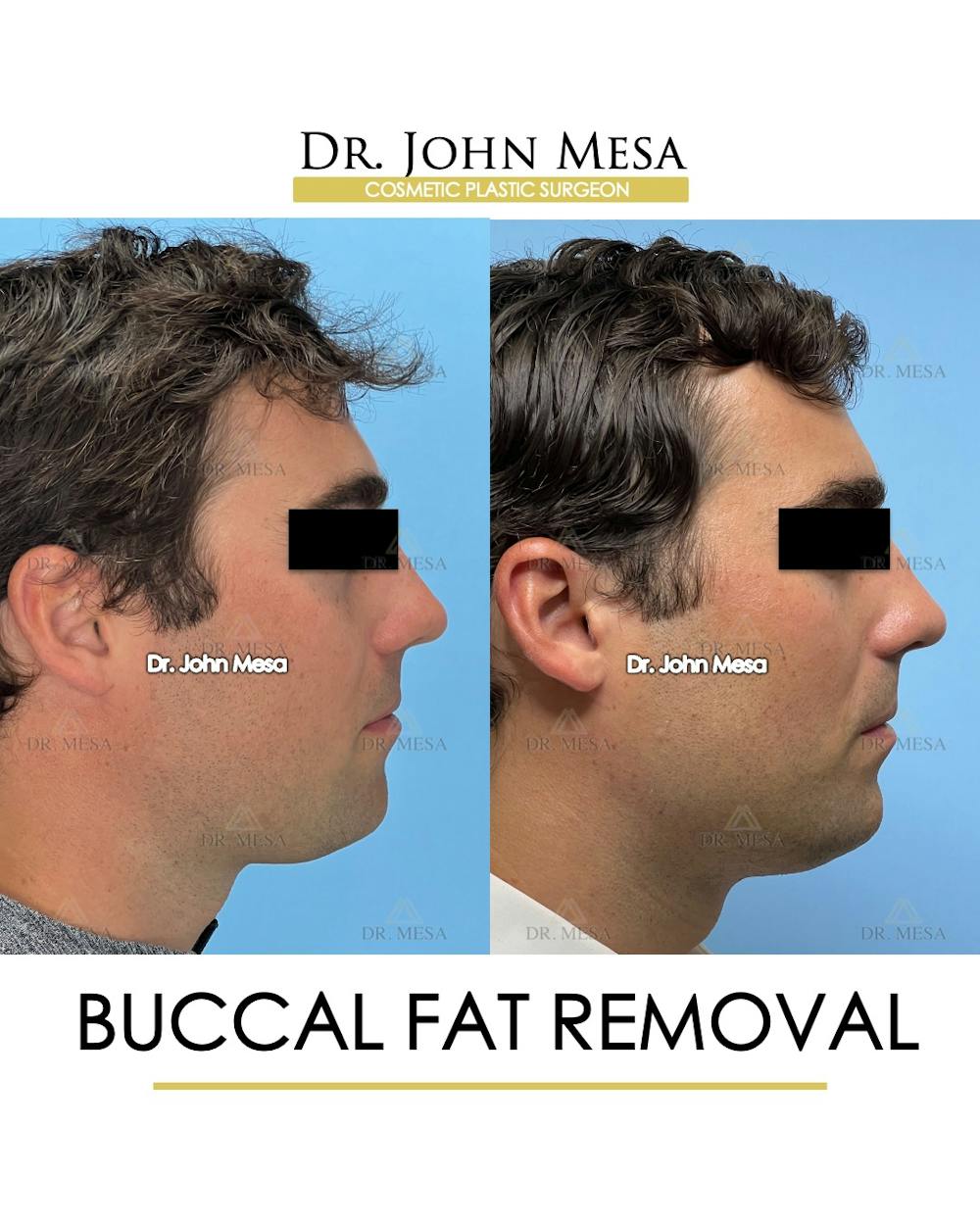 Buccal Fat Pad Removal for Men Before & After Gallery - Patient 174900776 - Image 3