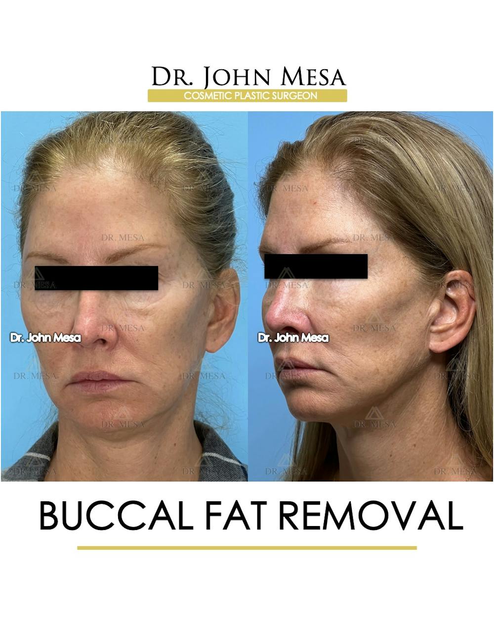 Buccal Fat Pad Removal Before & After Gallery - Patient 174900506 - Image 3