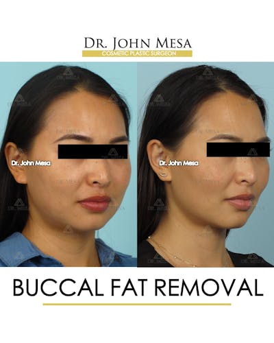 Buccal Fat Pad Removal Before & After Gallery - Patient 174900493 - Image 2
