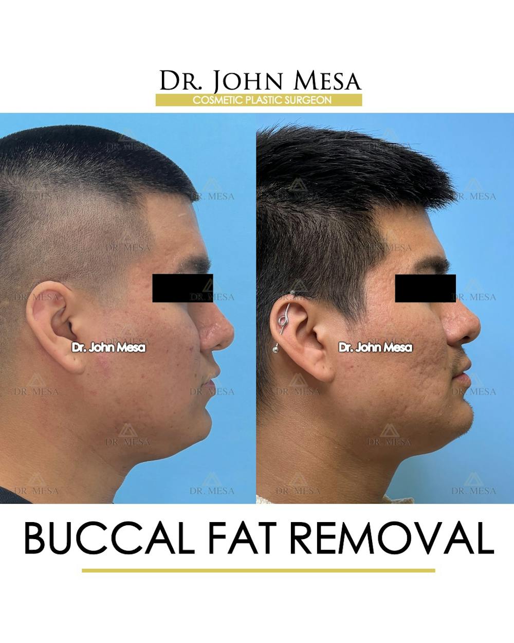 Buccal Fat Pad Removal for Men Before & After Gallery - Patient 174900584 - Image 3