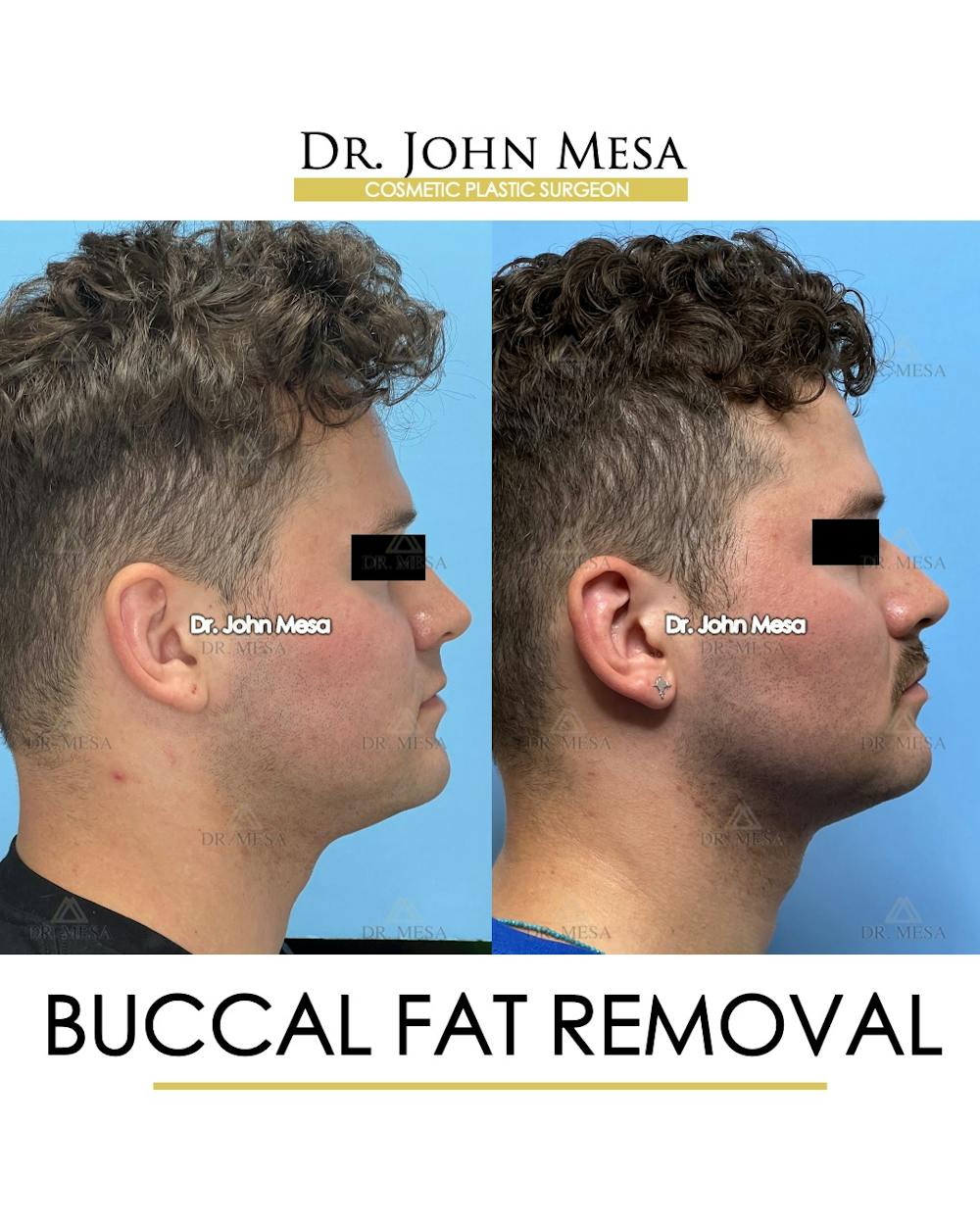 Buccal Fat Pad Removal for Men Before & After Gallery - Patient 174900507 - Image 4