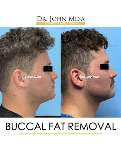 Buccal Fat Pad Removal for Men Before & After Gallery - Patient 174900507 - Image 4