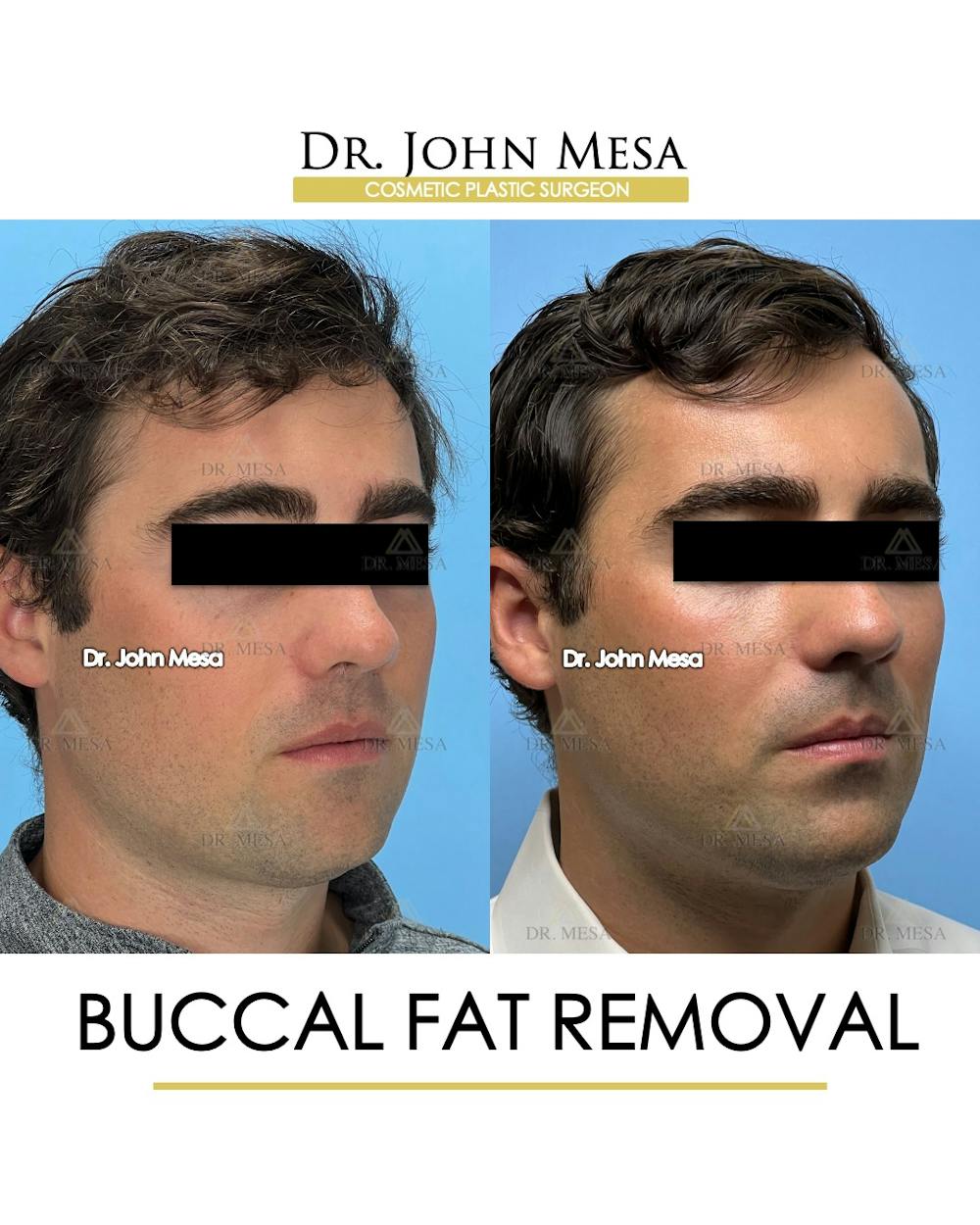 Buccal Fat Pad Removal for Men Before & After Gallery - Patient 174900776 - Image 2