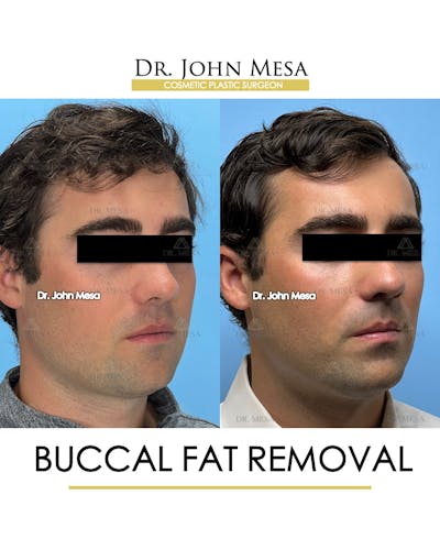 Buccal Fat Pad Removal for Men Before & After Gallery - Patient 174900776 - Image 2