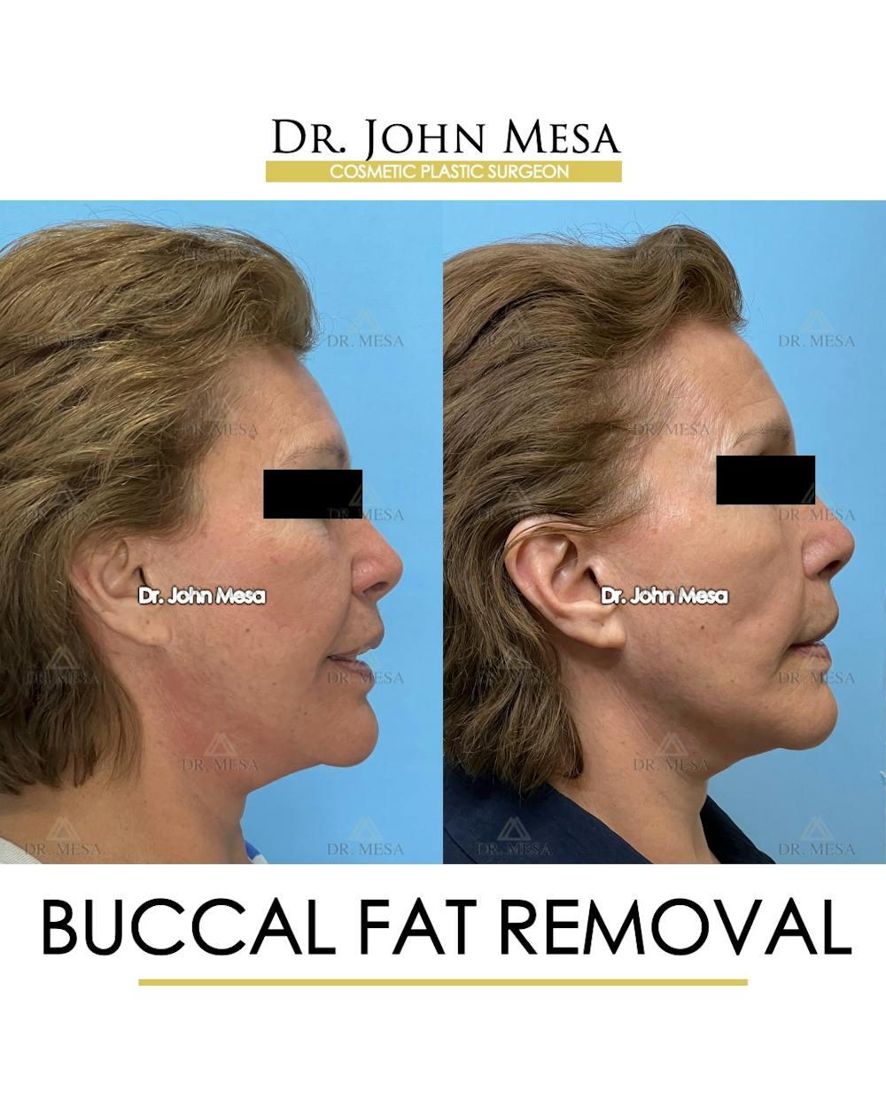 Buccal Fat Pad Removal Before & After Gallery - Patient 174900505 - Image 3