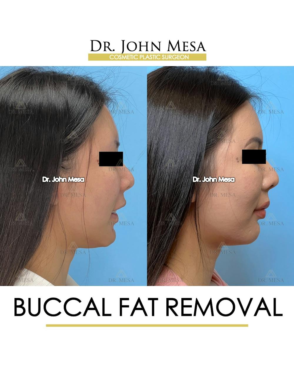 Buccal Fat Pad Removal Before & After Gallery - Patient 174900494 - Image 3