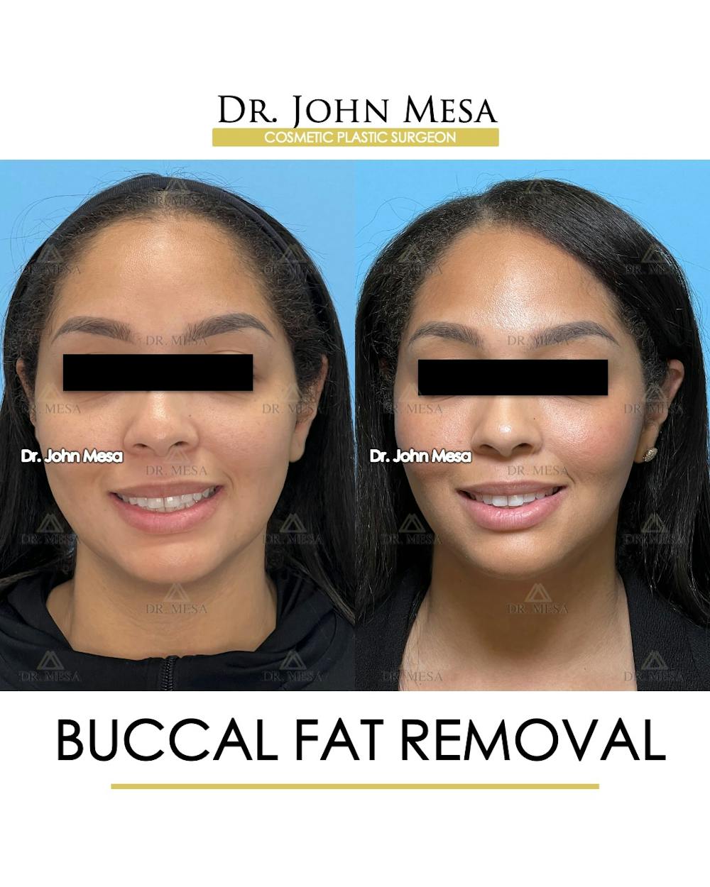 Buccal Fat Pad Removal Before & After Gallery - Patient 174900500 - Image 2