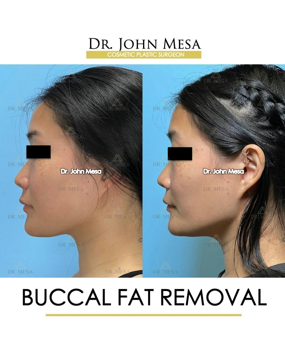 Buccal Fat Pad Removal Before & After Gallery - Patient 174900496 - Image 5