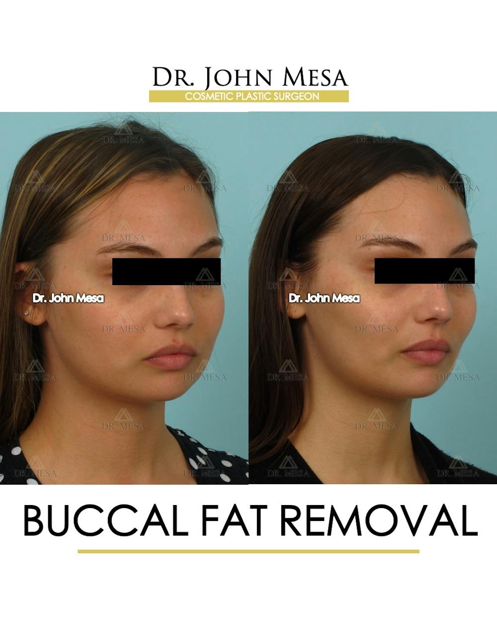 Buccal Fat Pad Removal Before & After Gallery - Patient 174900495 - Image 2