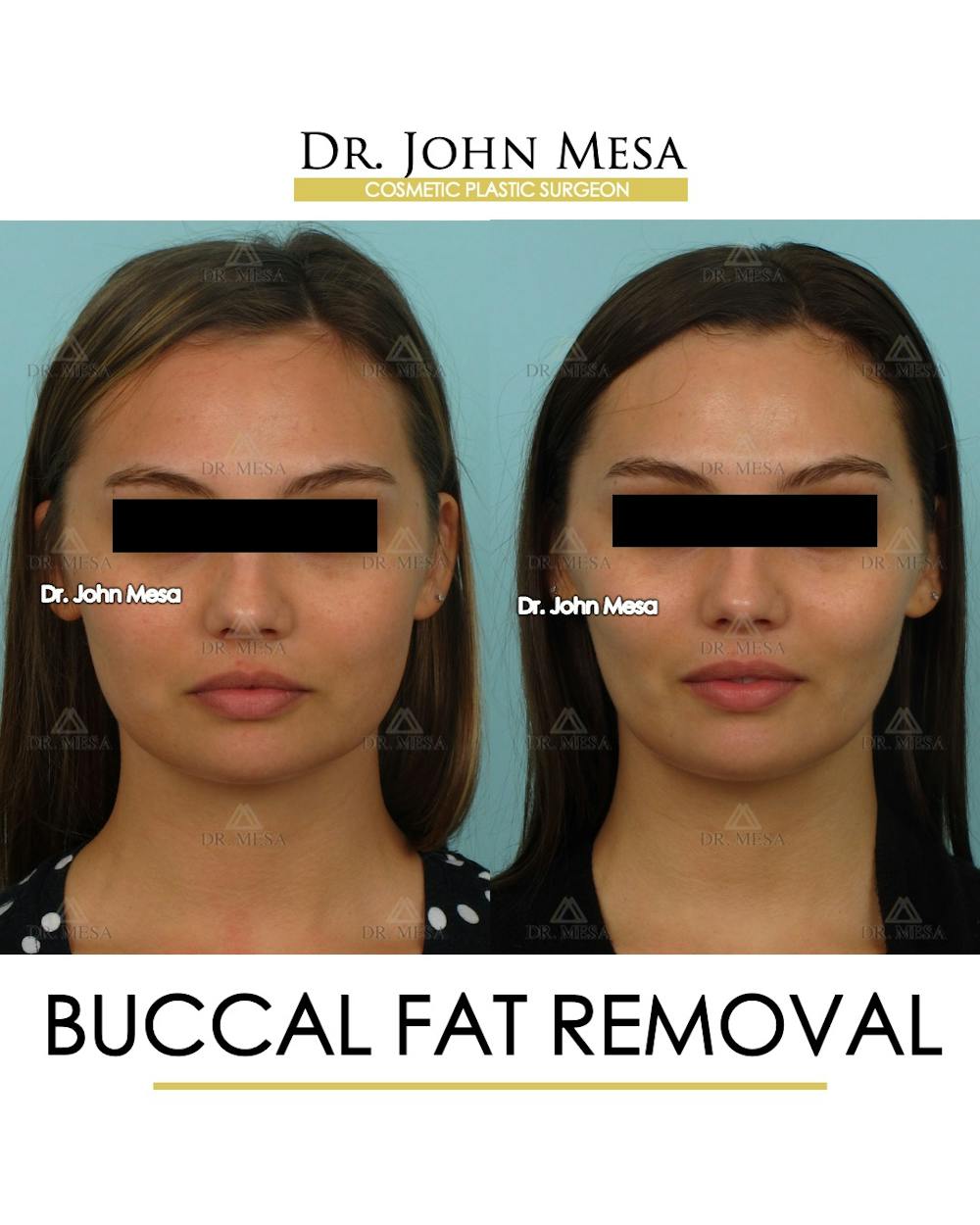 Buccal Fat Pad Removal Before & After Gallery - Patient 174900495 - Image 1
