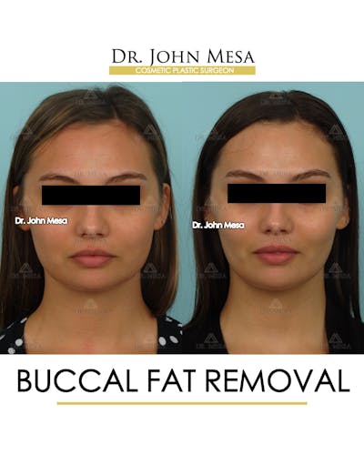 Buccal Fat Pad Removal Before & After Gallery - Patient 174900495 - Image 1