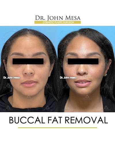 Buccal Fat Pad Removal Before & After Gallery - Patient 174900500 - Image 1
