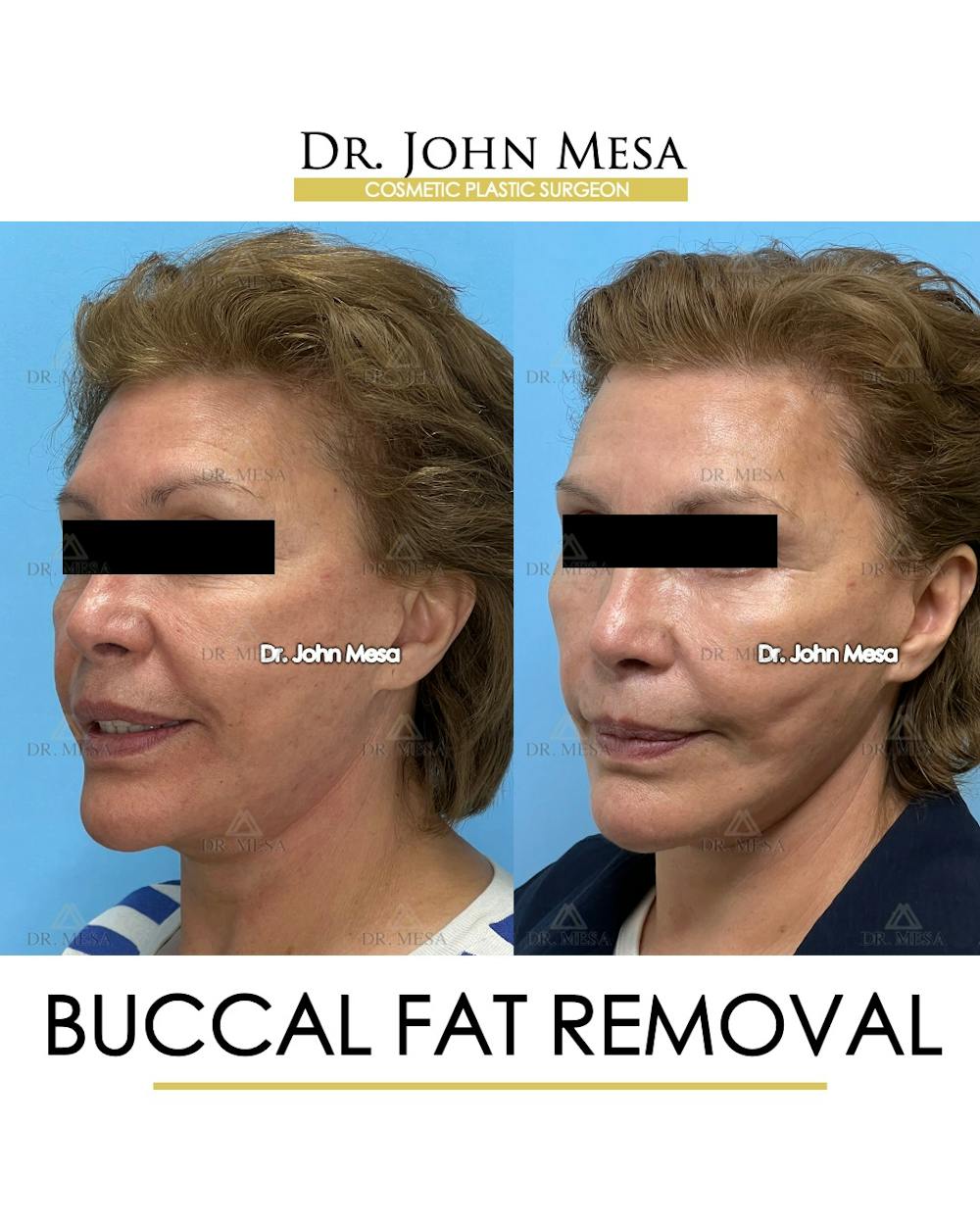Buccal Fat Pad Removal Before & After Gallery - Patient 174900505 - Image 4