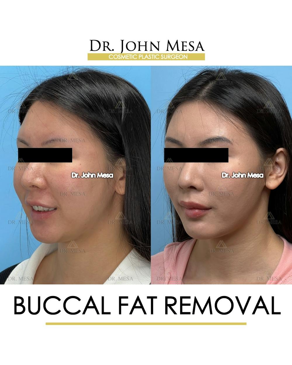 Buccal Fat Pad Removal Before & After Gallery - Patient 174900494 - Image 4