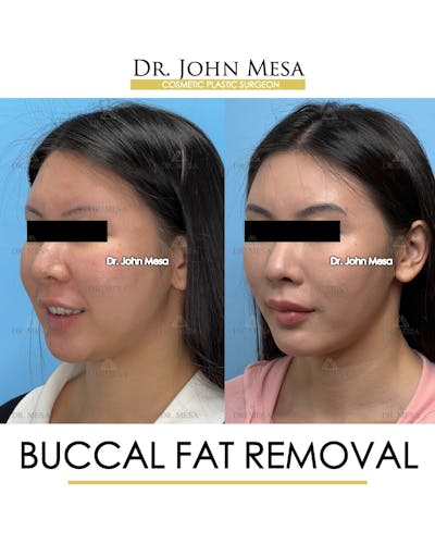 Buccal Fat Pad Removal Before & After Gallery - Patient 174900494 - Image 4