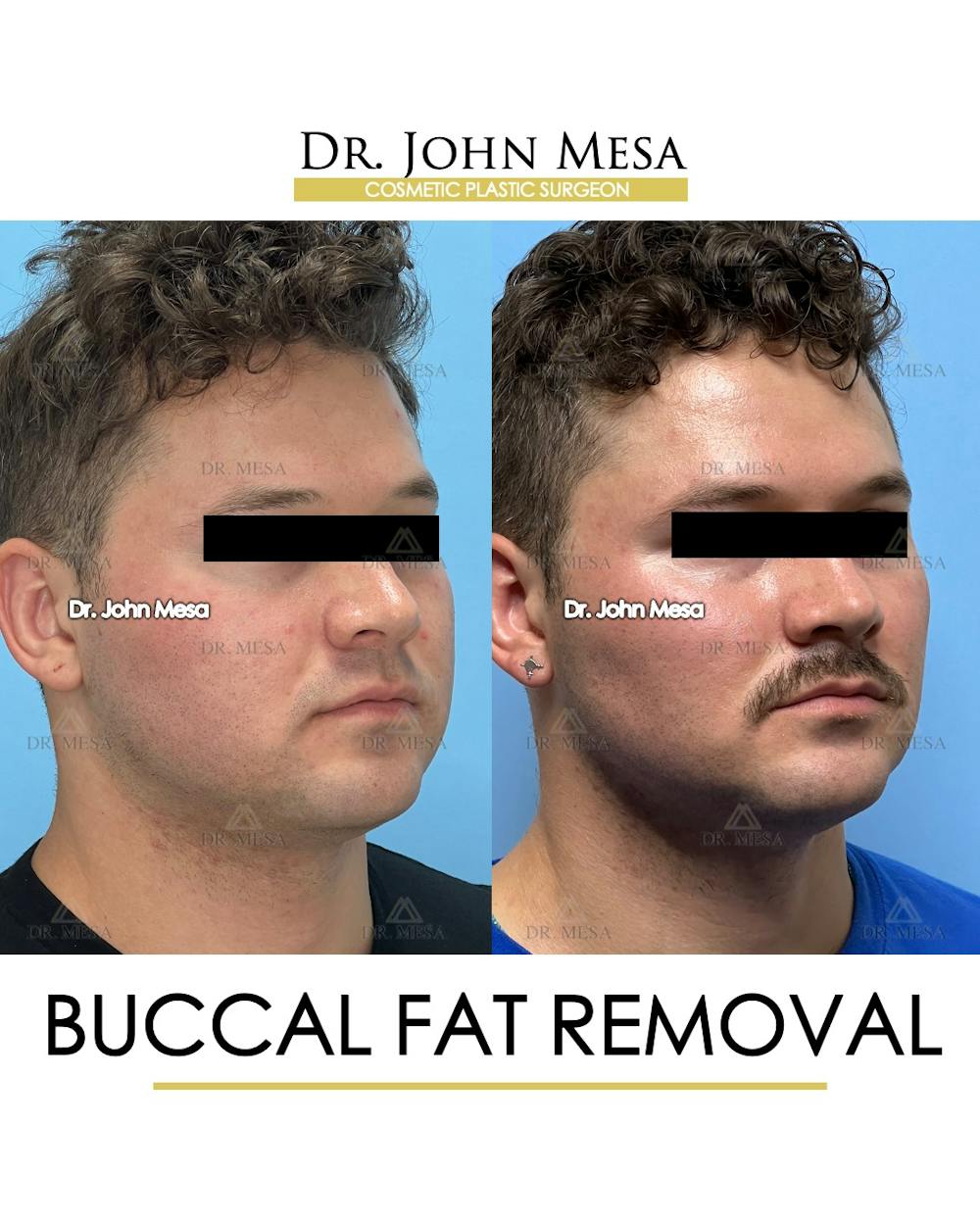 Buccal Fat Pad Removal for Men Before & After Gallery - Patient 174900507 - Image 3