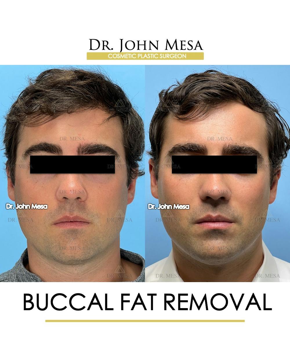 Buccal Fat Pad Removal for Men Before & After Gallery - Patient 174900776 - Image 1