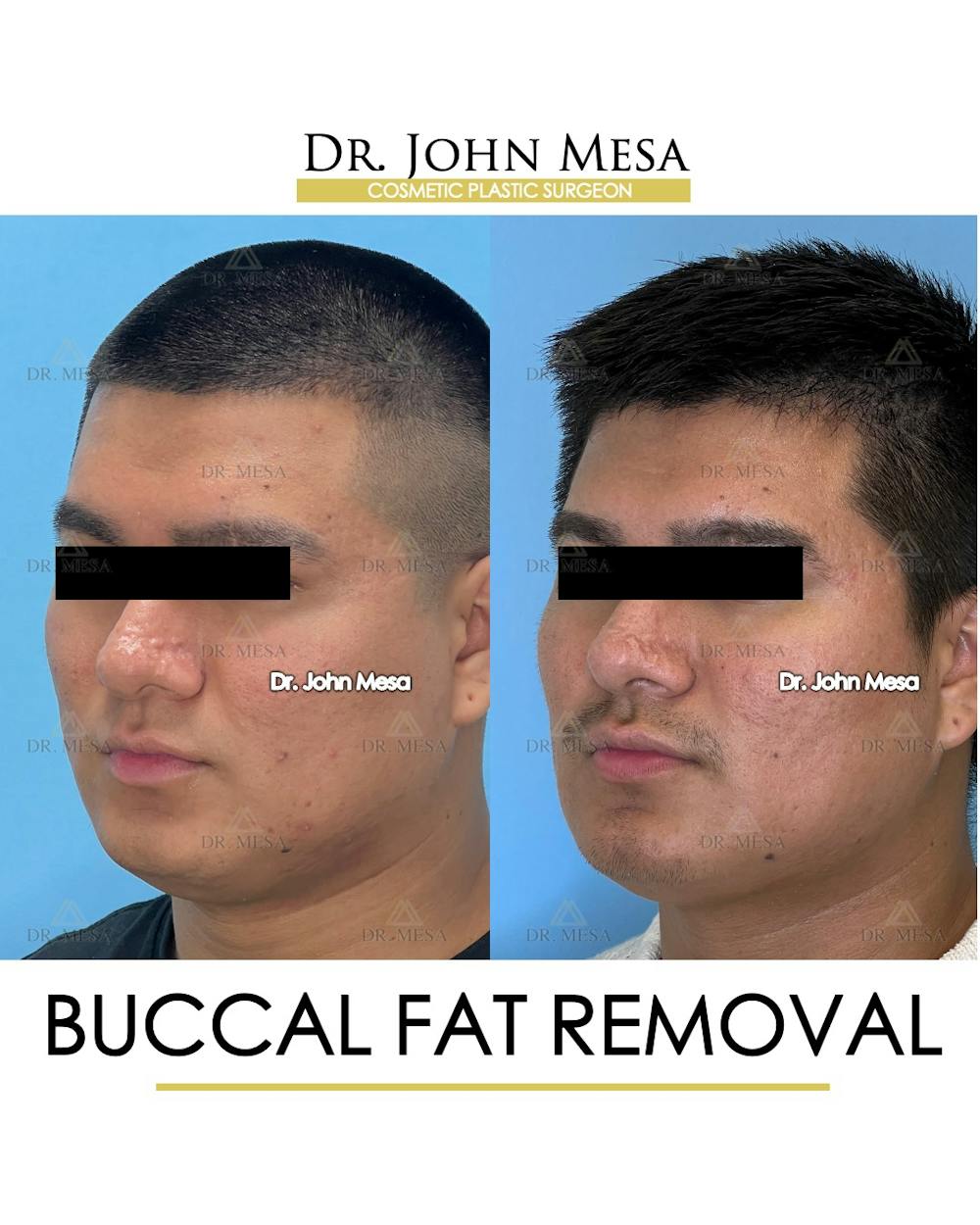 Buccal Fat Pad Removal for Men Before & After Gallery - Patient 174900584 - Image 4